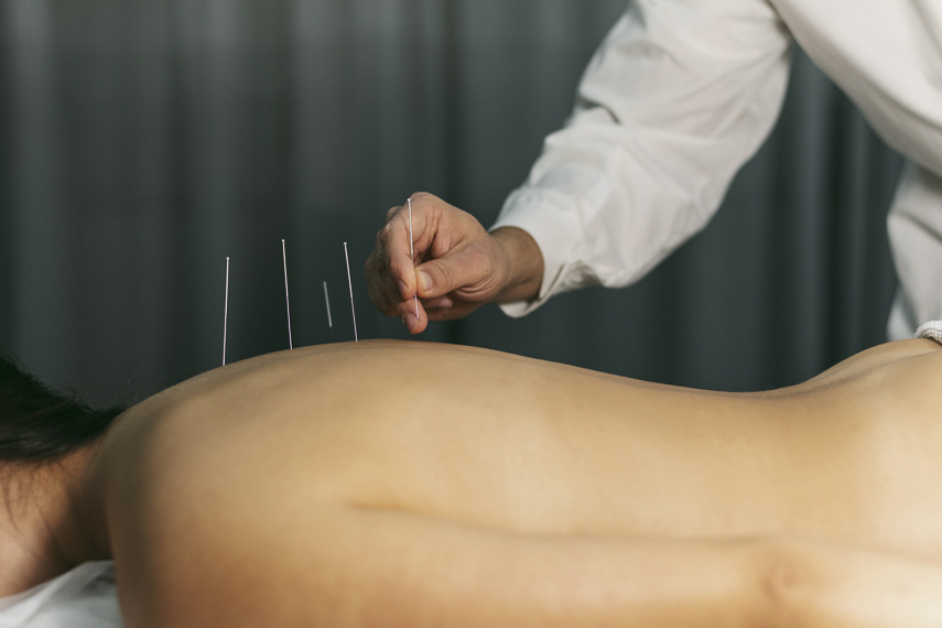 Acupuntura no Brasil: Nova Lei Regula Profissão e Define Critérios